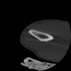 SPORK, NICO - 22.03.1976 - 02.08.2022 - CT obere Extremität - 17:51:17